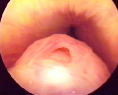 Нормальная уретроскопическая картина семенного бугорка