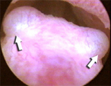 Трихомонадные инфильтраты (стрелки)