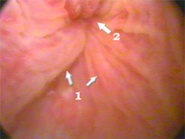 Инфильтративный отек складок слизистой
