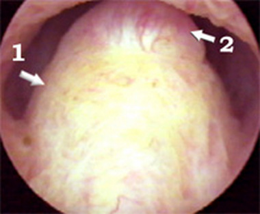 Трихомонадный инфильтрат