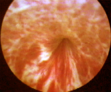 Нормальная эндоскопическая картина сфинктера